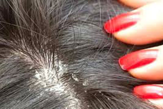 4 công thức không mất tiền mà sạch gàu vĩnh viễn