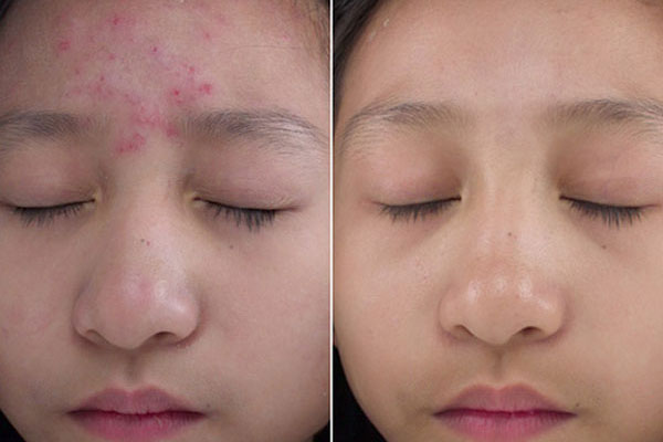 4 loại rau quen thuốc giúp bạn không phải lo về mụn trứng cá