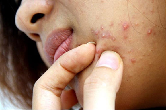 Thay đổi thói quen này bạn sẽ không phải lo mụn