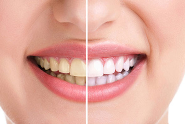 Răng trắng bóng chỉ sau 3 lần sử dụng vỏ chanh