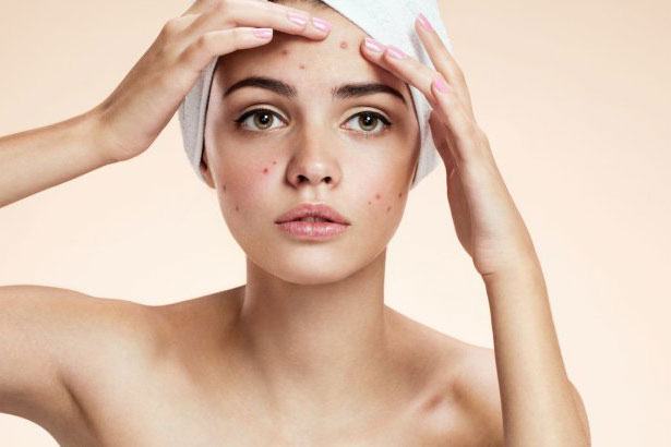 Lấy sạch nhân mụn để làn da hồng hào, sáng mịn