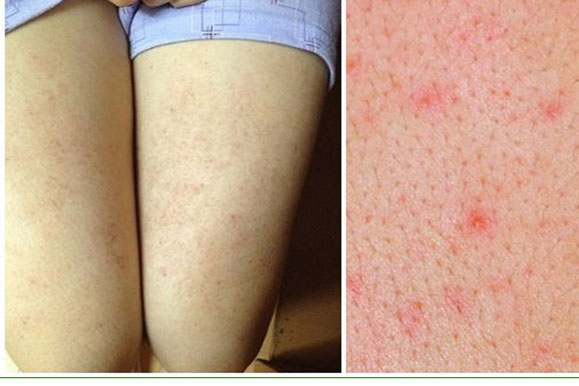 Chữa viêm lỗ chân lông chưa bao giờ đơn giản đến thế