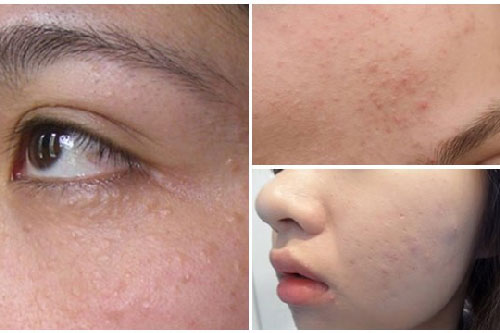 Chỉ với 3 bước mụn ẩn dưới da sẽ biến mất
