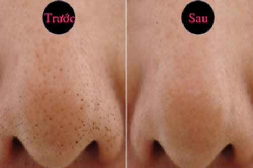 4 bước để mụn đầu đen không bao giờ tìm đến bạn