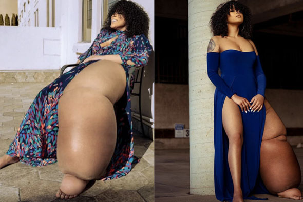 Cô gái mắc bệnh lạ khiến 1 chân không ngừng phù ra, bị trêu chọc là “quái vật” nhưng cơ thể và cuộc sống hiện tại khiến ai cũng thán phục