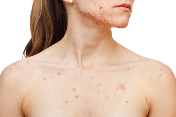 3 c&#xE1;ch kh&#x1EAF;c ph&#x1EE5;c t&#xEC;nh tr&#x1EA1;ng m&#x1EE5;n &#x1EDF; ng&#x1EF1;c