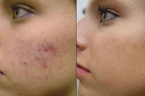 4 lý do khiến thâm mụn không thể hết được