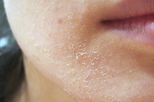 Dấu hiệu làn da đang bị hủy hoại