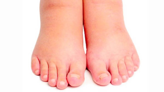 7 biện pháp tự nhiên “xử lý” phù nề hiệu quả