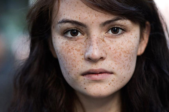 Công thức trị tàn nhang từ thiên nhiên