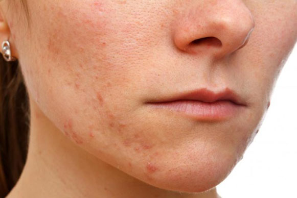 Cách trị mụn cám từ thiên nhiên bạn phải nhớ