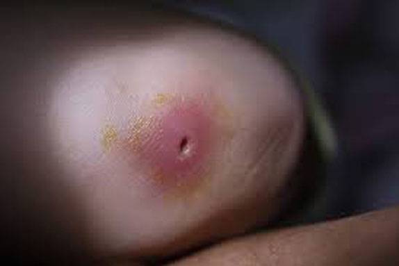 Chữa mụn nhọt bằng phương pháp đơn giản