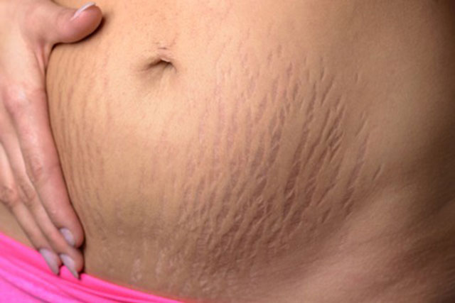 Bạn có thể trị rạn da hiệu quả bằng cách dùng dầu dừa