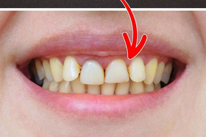 6 thói quen khiến răng bạn ố vàng