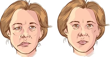 Méo miệng (ảnh trái) - Di chứng thường gặp ở người đột quỵ não.