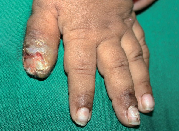 Bí ẩn căn bệnh tự "ăn thịt" chính mình, ám ảnh chưa được giải mã