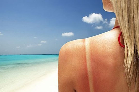 5 thực phẩm cứu làn da cháy nắng