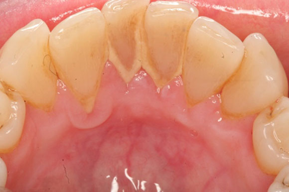 Ngậm đường 5 phút mảng bám, cao răng sẽ bong sạch