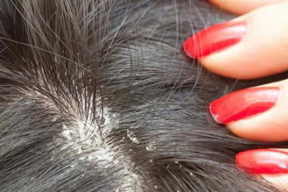 Thực phẩm cấm bạn ăn khi da đầu bị gàu