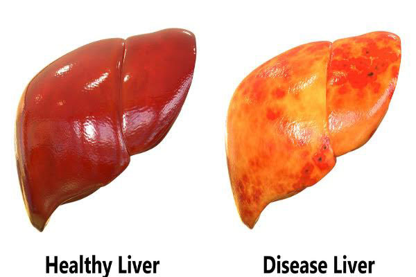 Bệnh nhân xơ gan nên ăn và nên tránh thực phẩm gì