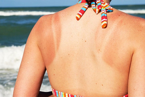 Hiểu lầm tai hại khiến bạn tăng nguy cơ cháy nắng da