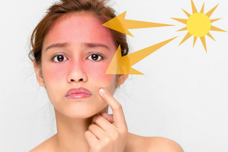 Điều bạn tuyệt đối không nên làm khi da bị cháy nắng