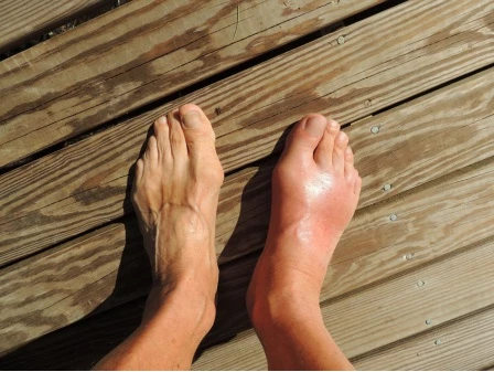 Gout ở mu bàn chân khiến người bệnh gặp khó khăn trong sinh hoạt hàng ngày.