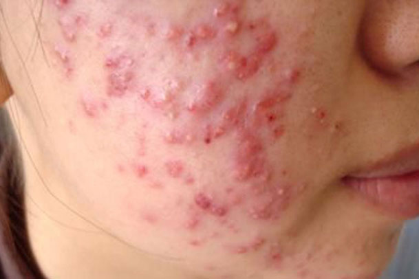 Quy trình trị mụn trứng cá tại nhà bạn phải nhớ