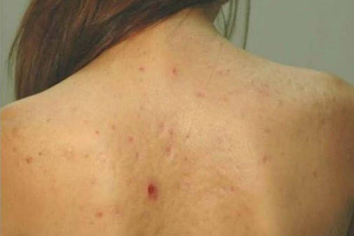 Cách khắc phục tình trạng mụn ở lưng đơn giản nhất