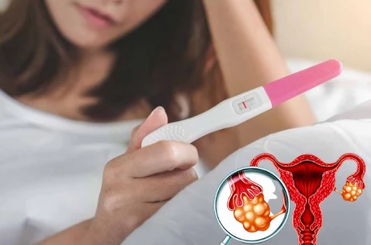 U nang buồng trứng làm suy giảm khả năng mang thai ở phụ nữ.