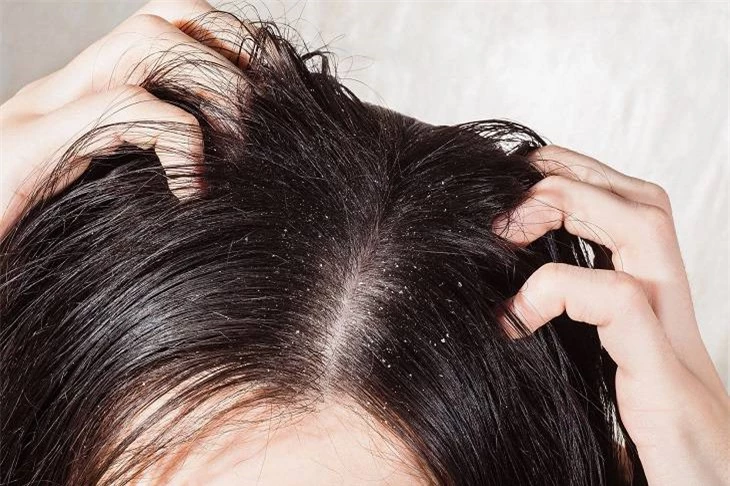 Gàu ngày càng tổi tệ vì nguyên nhân không ngờ tới