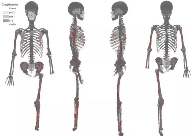 Giải mã bí ẩn bộ xương người tiền sử cụt chân: Cái chết rùng rợn, đau đớn, kinh hoàng ảnh 1