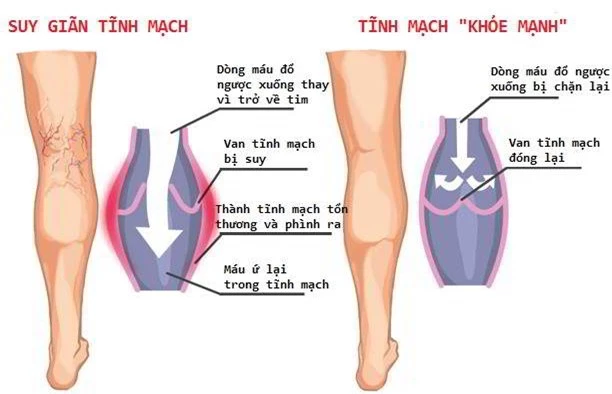 Cẩn trọng với chứng suy giãn tĩnh mạch ở dân văn phòng gây phù chân, đột tử