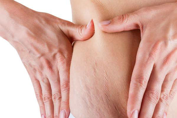 5 mẹo đơn giản giúp bạn xóa sạch những vết rạn da xấu xí