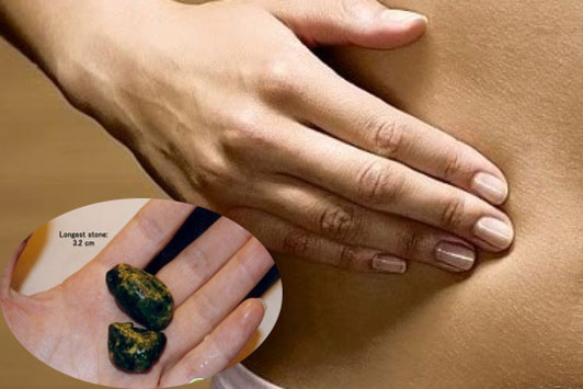 Dấu hiệu cảnh báo bệnh sỏi mật, nguyên nhân và cách điều trị