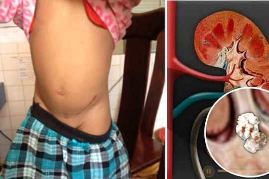 Mẹ khiến con mới 4 tuổi đã sỏi thận vì uống nước cam tươi kiểu này!