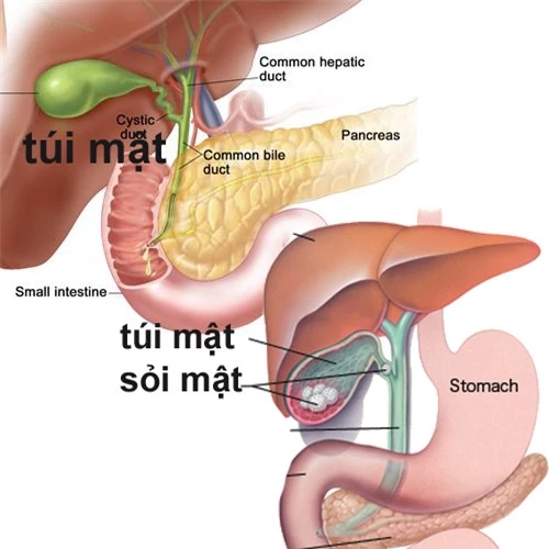 đánh tan sỏi mật bằng loại quả dân dã