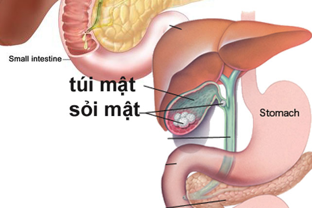 Đánh tan sỏi mật bằng loại quả dân dã không phải ai cũng biết