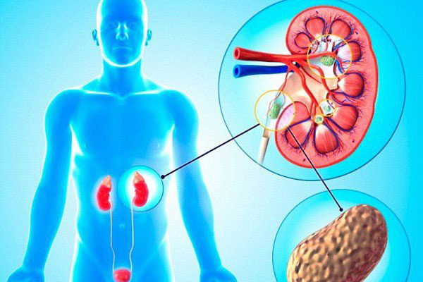 Bài thuốc dân gian ‘đánh tan’ sỏi thận thần tốc chỉ từ quả dứa