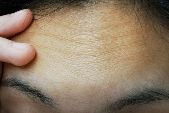 7 cách để loại bỏ và ngăn ngừa nếp nhăn trên trán