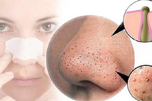 Bí quyết trị mụn đầu đen đơn giản, hiệu quả
