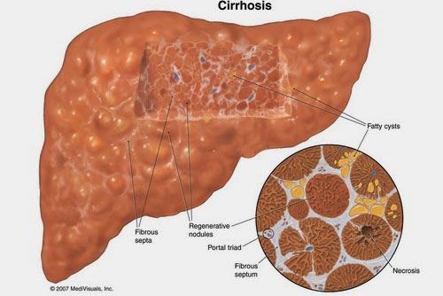 Người bị bệnh gan nên ăn gì để phòng bệnh?