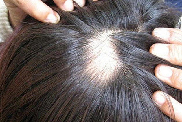 Làm tóc ở chỗ quen, người phụ nữ hoảng loạn vì hói cả mảng đầu chỉ sau 1 đêm