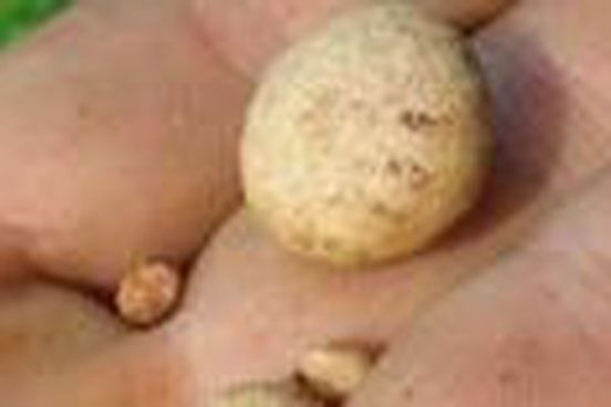 Sỏi thận từ những thói quen ăn uống mà người Việt thường xuyên mắc phải