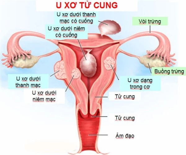 U xơ tử cung, thực phẩm nào nên và không nên ăn?