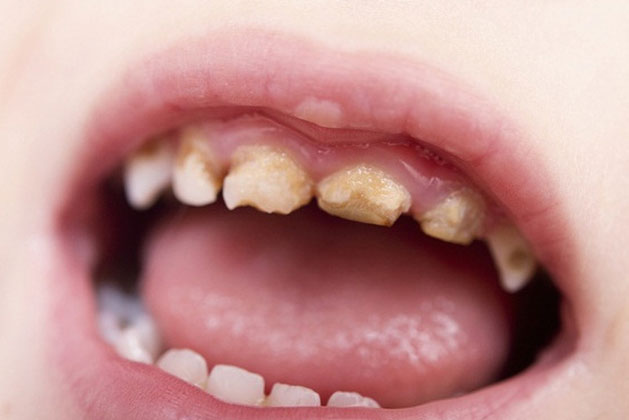 7 thói quen gây hại cho răng ai cũng nên biết