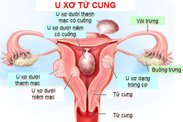 U xơ tử cung: Thực phẩm nào nên ăn và tuyệt đối phải tránh xa?
