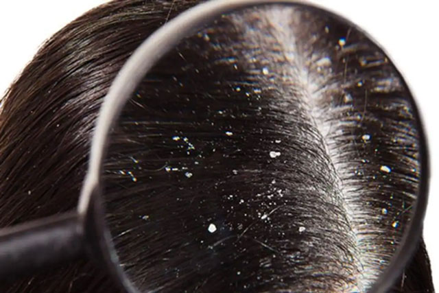 5 mẹo đánh bay gàu tự nhiên tại nhà