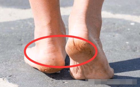 Nếu bàn chân có dấu hiệu này thì 80% 'ung thư gan', hãy nhanh chóng đi kiểm tra