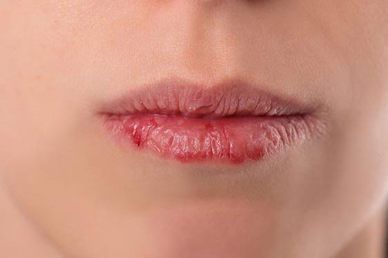 4 đặc điểm trên mặt bất thường cho thấy chị em đang mắc bệnh phụ khoa